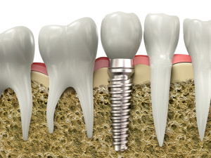 Implantul dentar