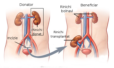 Transplantul renal