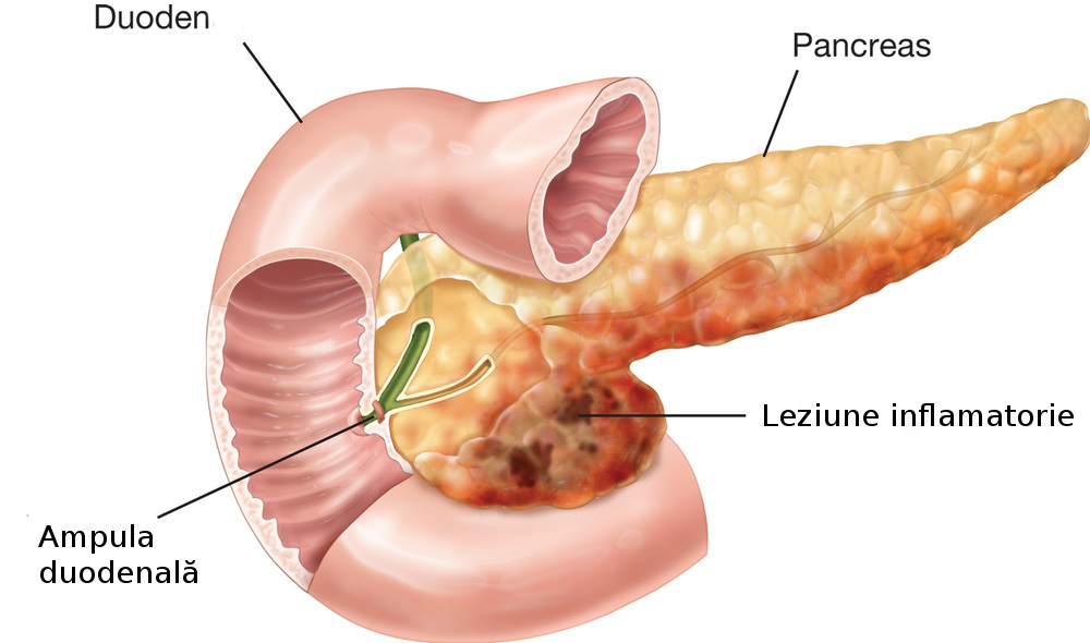 ce este pancreatita acuta?